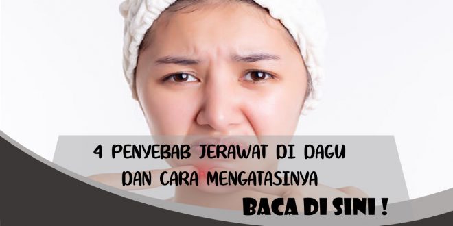 PENYEBAB JERAWAT DI DAGU DAN CARA MENGATASINYA