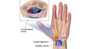 Wrist pain exercises