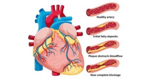 Foods that cause plaque buildup