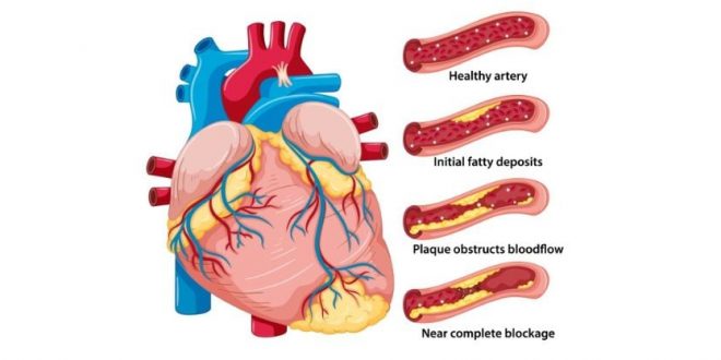 Foods that cause plaque buildup